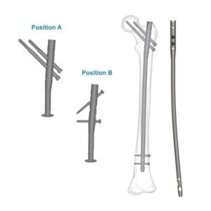 Aduera™ Expert Femur Nail – Titanium