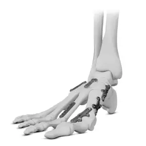ANKLELOCK Variable Angle Forefoot & Midfoot 2.4/2.7 mm System