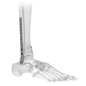 Ankle Arthroscopy Implants
