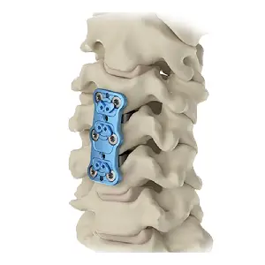 Anterior Cervical Plating System