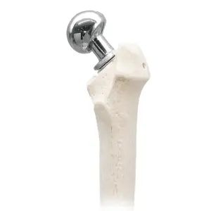 Bipolar Prosthesis