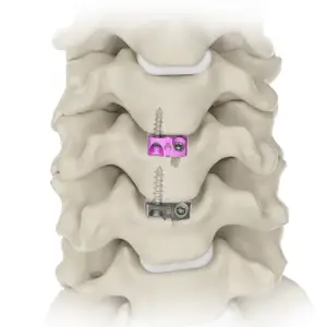 Cervical Interbody Fusion System