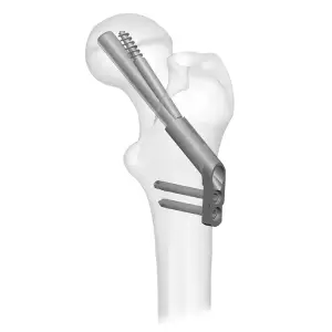 Femoral Neck System