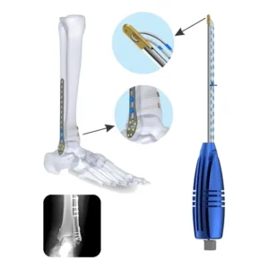 Flex Rope for Syndesmosis Repair, titanium – Sterile