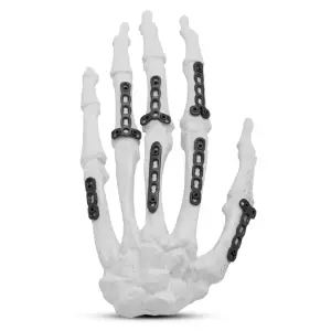 MicroLock Locking Hand System