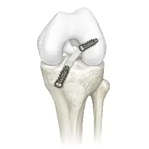 Knee Arthroscopy Implants