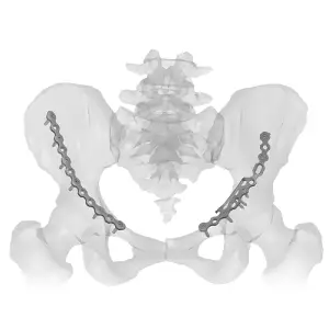 Low Profile Pelvis Plating System