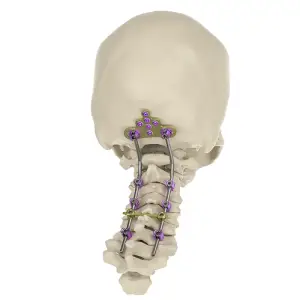 Occipital Screw System