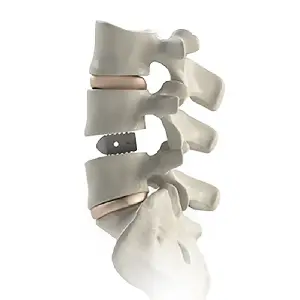 PILF Interbody Fusion Cage