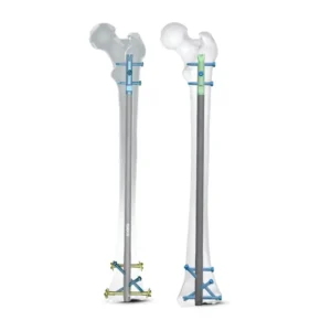 Rigifix Multilock Retrograde Femoral Nail