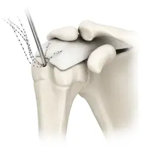 Shoulder Arthroscopy Implants