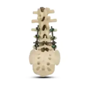 Spine Implants