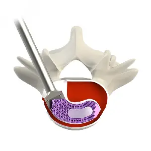 TILF Interbody Fusion Cage