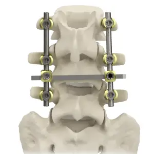 Pedicle Screw System